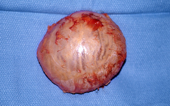 silikónový prsný implantát